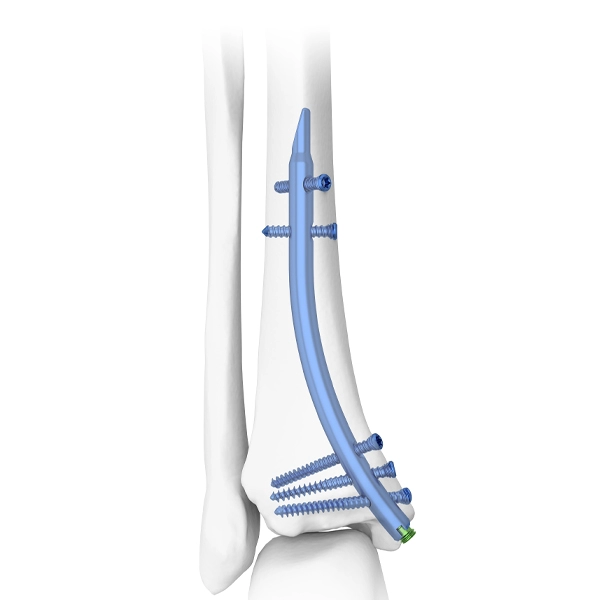 Clou tibial distal DTN